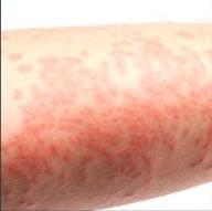 各种儿童皮疹的收藏版文章：湿疹、痱子、手足口、急疹……