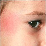各种儿童皮疹的收藏版文章：湿疹、痱子、手足口、急疹……