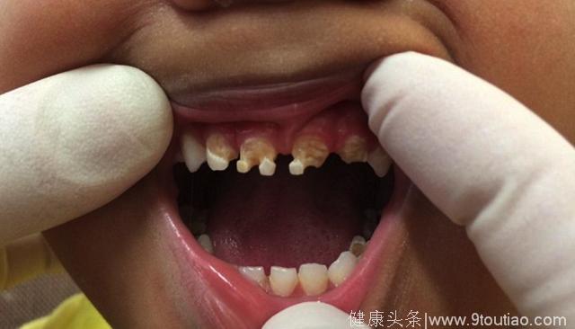 牙医用真实的图片告诉你 饮料对儿童牙齿伤害有多大