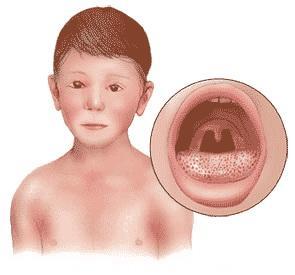 从容面对：幼儿常见细菌性传染病——猩红热的四大类型及三个症状