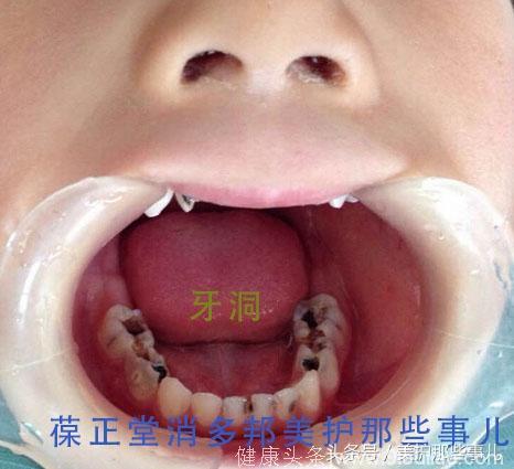 儿童龋齿问题不大，大错特错！