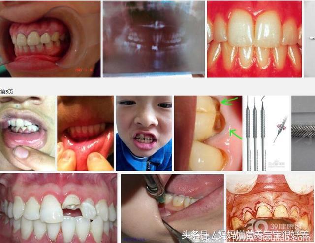 孩子天天刷牙不吃糖，还是有80%儿童乳牙就龋齿了！为何？