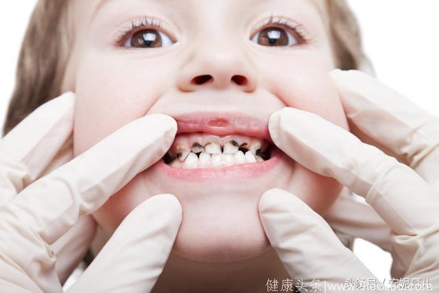 儿童虫蛀牙发病率越来越高，听听专家怎么说
