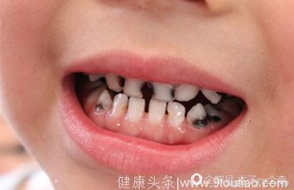 两岁儿童牙齿全坏变成竹签状的原因居然是这个，而不是吃糖与零食