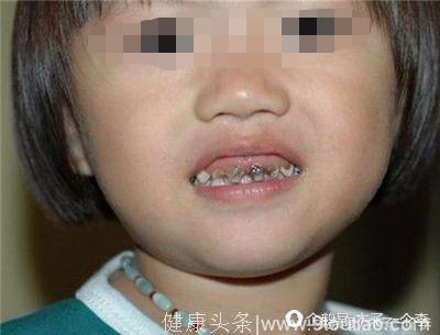 两岁儿童牙齿全坏变成竹签状的原因居然是这个，而不是吃糖与零食
