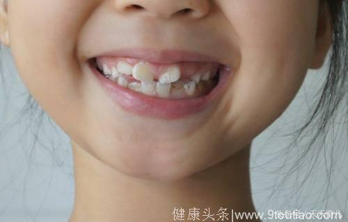 宝宝牙齿不齐的原因及危害，矫正牙齿的最佳年龄及费用