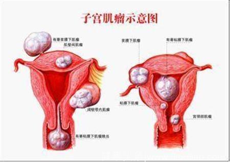 患有子宫肌瘤是什么原因 避孕药也会引发子宫肌瘤