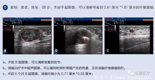 射频消融，乳腺纤维瘤治疗“针”功夫