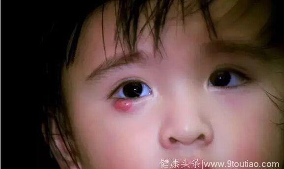 家长同志注意了：儿童常见眼疾霰粒肿，为了宝宝，做好预防！