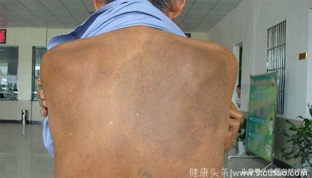 六味地黄丸如何治疗各类皮肤病，97岁中医大师陈彤云秘方公布