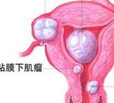 子宫肌瘤不可怕，中医治疗子宫肌瘤是怎样的