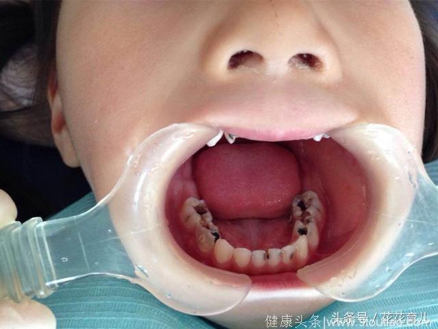 不要以为宝宝乳牙可以换，妈妈就可以疏忽大意！