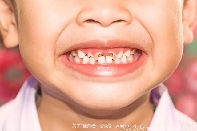 家长们注意了：为什么刚萌出的牙齿会更容易蛀牙？
