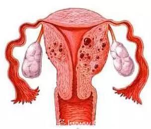 腺肌病和子宫肌瘤有什么关系？