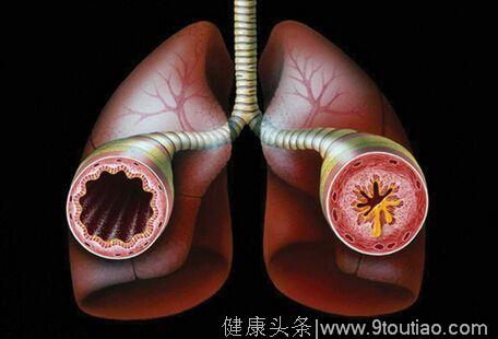 咳嗽变异性哮喘的8大症状