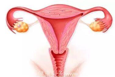 子宫内膜癌——与激素持续作用相关
