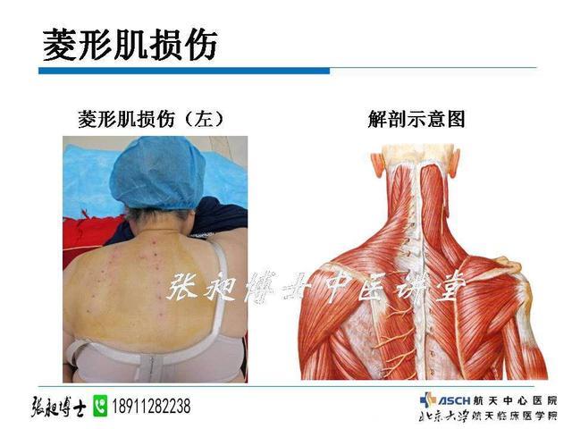 小科普——肩背痛就是“肩周炎”吗？