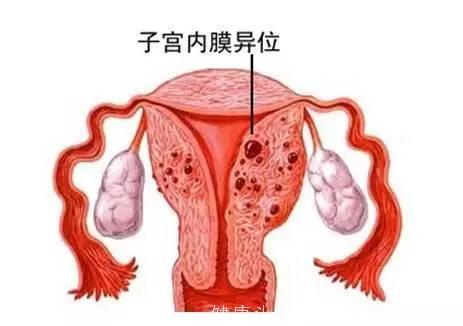 子宫内膜异位症的药物治疗