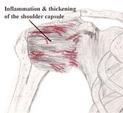 图解肩周炎，几个小动作可以缓解