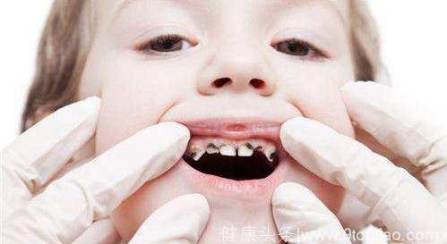 预防儿童龋齿仅仅刷牙还不够！漏了哪一步？