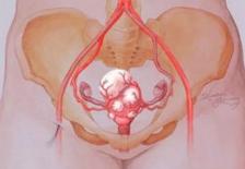 子宫出血需警惕子宫肌瘤来袭