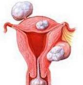 子宫出血需警惕子宫肌瘤来袭