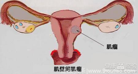 老蚌生珠”引发闹剧，竟是子宫肌瘤作怪！