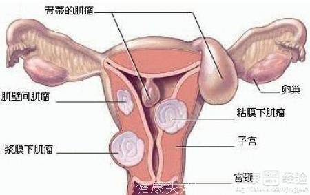 老蚌生珠”引发闹剧，竟是子宫肌瘤作怪！