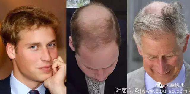 治脱发：民间偏方vs秃头医生，你能信谁？