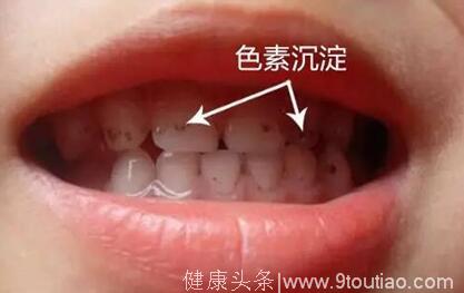 小朋友牙齿上的黑色素能去掉吗？