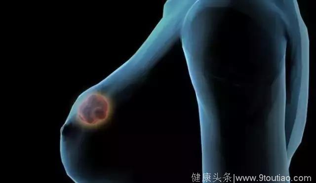 乳腺增生会导致乳腺癌吗？