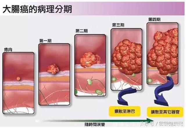 大便带血未必是痔疮，4个症状可能是大肠癌，3个偏方见效快