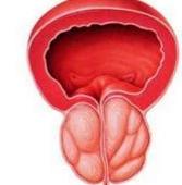 前列腺里也会长石头 带您了解前列腺结石的症状