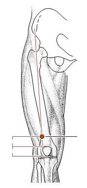 膝骨关节炎循证针灸实践
