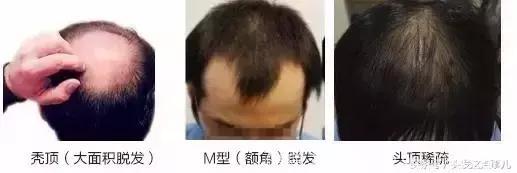 脱发、秃顶、M型脱发、脂溢性脱发……如何彻底解决脱发？