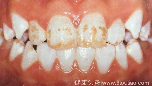 牙科博士揭开儿童护牙的常见误区，看看你错了几条？