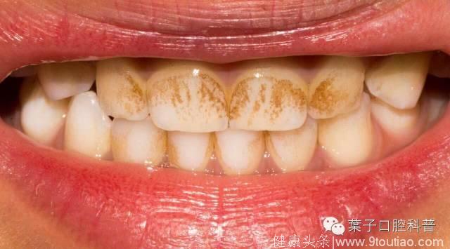牙科博士揭开儿童护牙的常见误区，看看你错了几条？