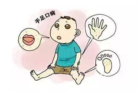 “手足口病”进入高发期，这病严重吗？怎么预防？