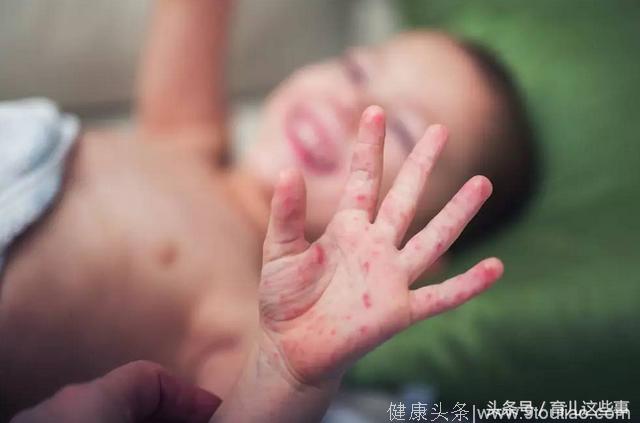 新爸妈必读：宝宝手心长疹子，有可能是手足口，别当湿疹处理了