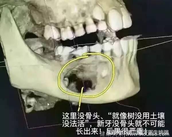颌骨出现一个洞只因一颗龋坏的乳牙！