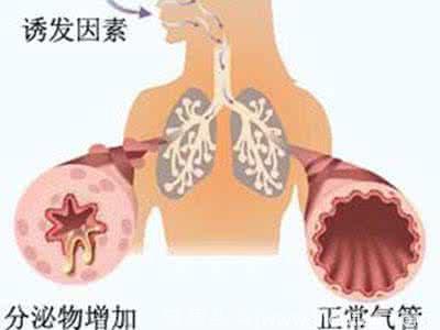 购买空气净化器可以减少哮喘诱发原吗？