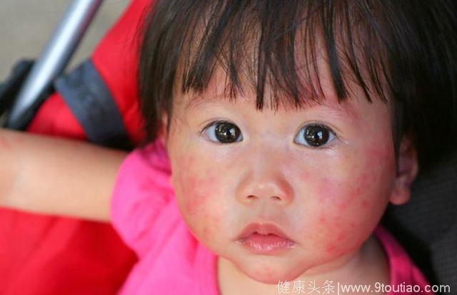 儿童过敏3大症状中西医对策：异位性皮肤炎，先止痒！