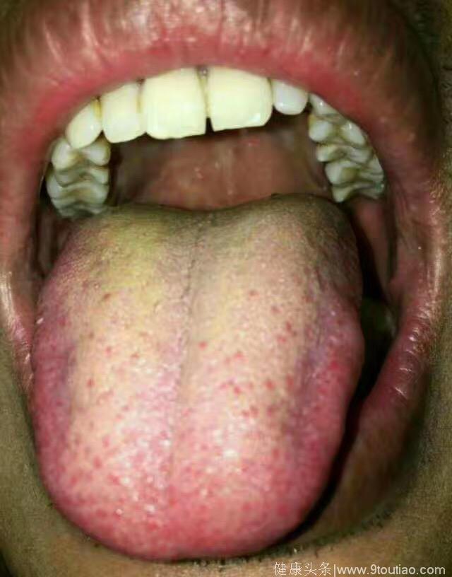 这样的舌苔可能是前列腺炎，要小心了！