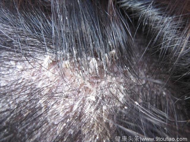 头皮又油又痒脱发很严重，一个脂溢性脱发的典型病例，不妨参照下
