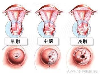 子宫出现这三种病变不要忽视，拖久了会变成宫颈癌！