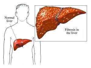 脂肪肝的“克星”是它，平时吃这几样东西，让你远离脂肪肝
