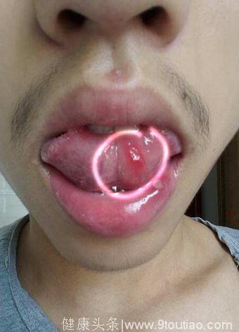 口腔溃疡反复发作，4个土方法可以根治