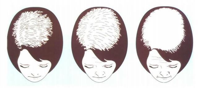 女性型秃发诊治流程图