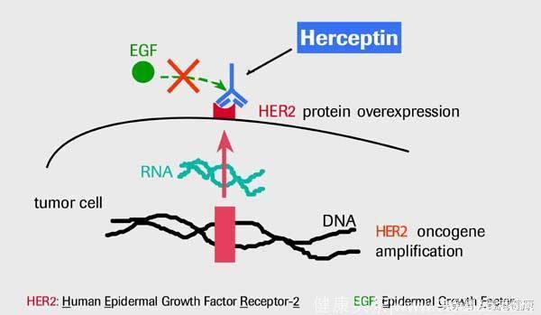 赫赛汀被批准用于HER2阳性高级胃癌治疗