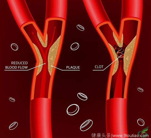 血管堵塞跟什么有关系？